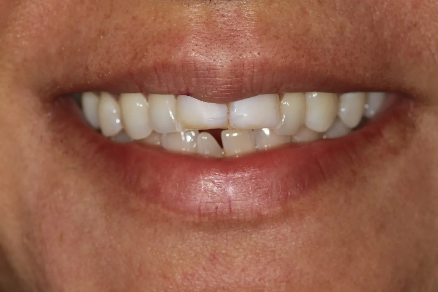 Before: Fixing a reverse smile arc with aligners, two crowns and whitening, without veneers
