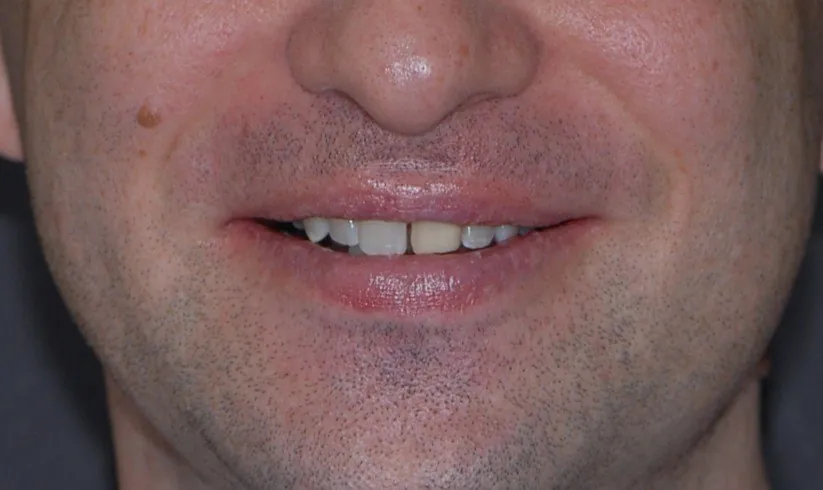 Before treatment