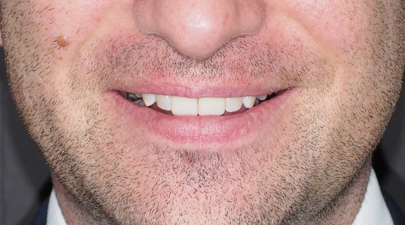 After: Invisalign and no-prep veneers for a discoloured front tooth