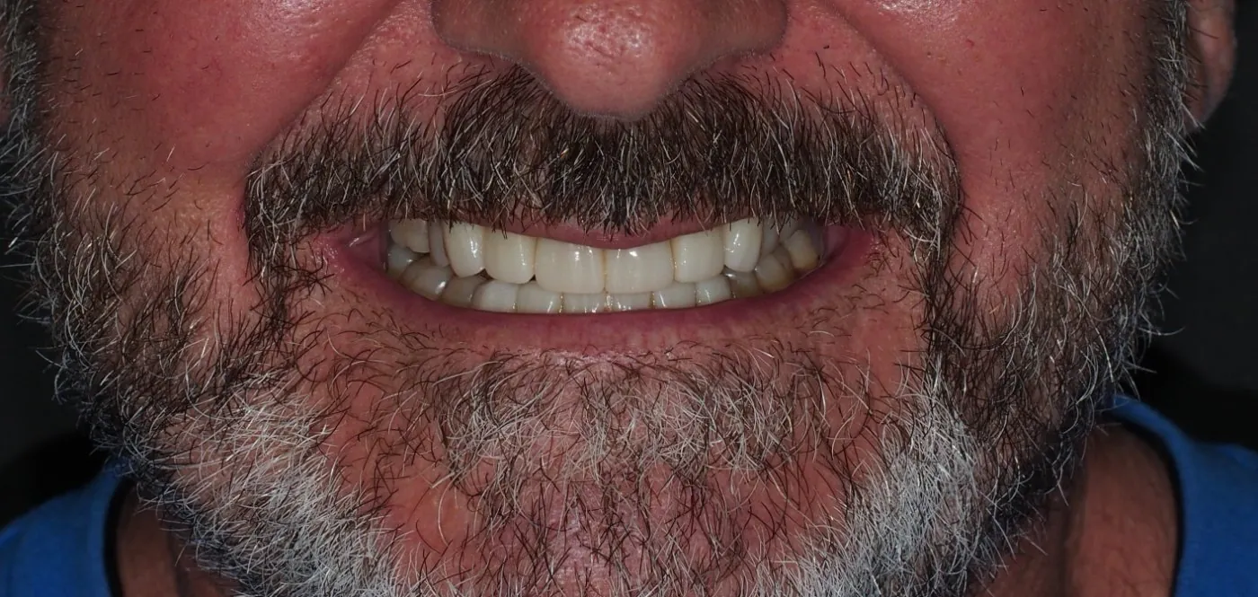 After treatment