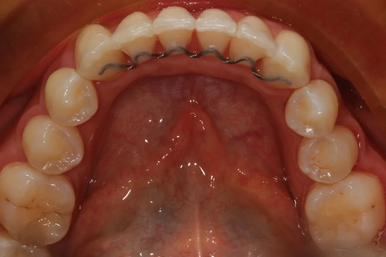 After: Invisalign for lower front teeth that moved after braces