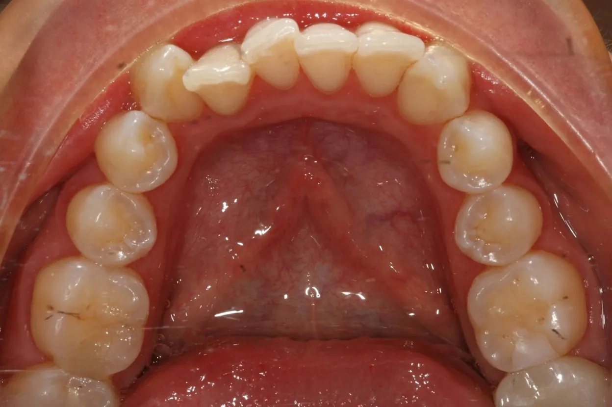 Before: Invisalign for lower front teeth that moved after braces