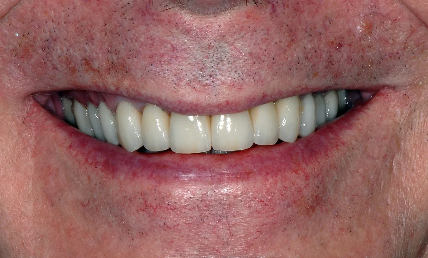 After: Four crowns to fix a reverse smile line, gaps and staining