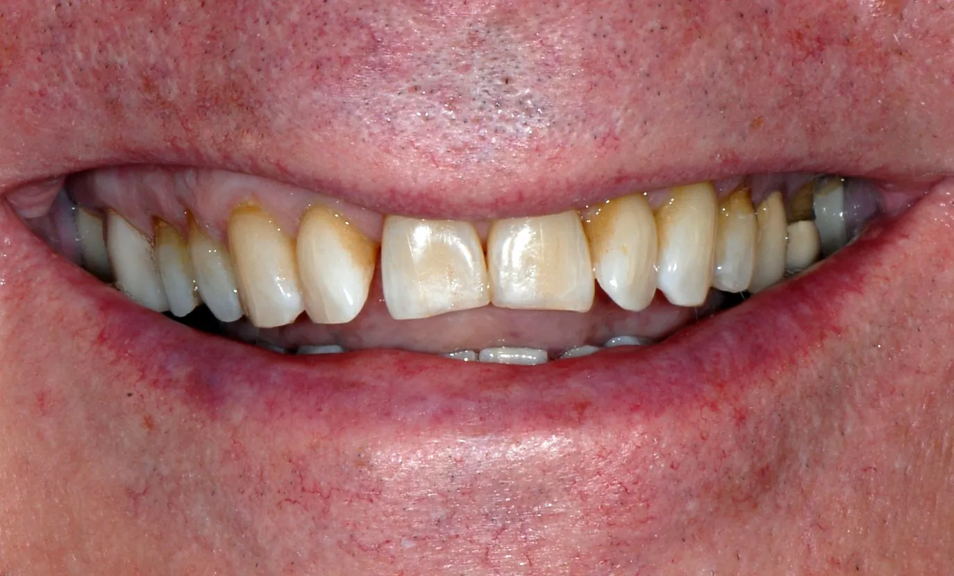 Before: Four crowns to fix a reverse smile line, gaps and staining
