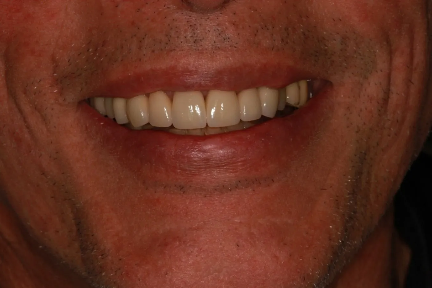 After: Six crowns to replace failing restorations and even out prominent front teeth