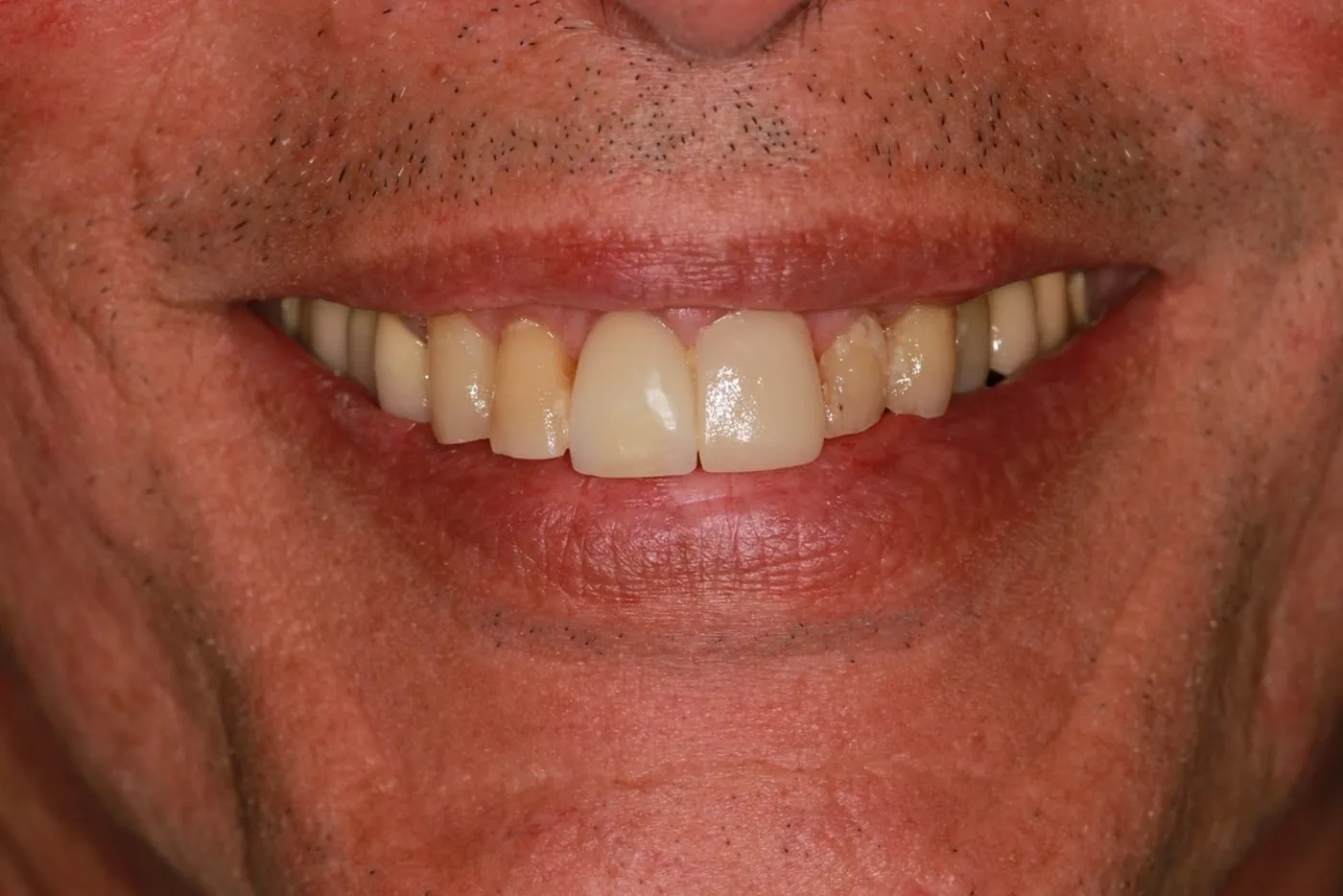 Before: Six crowns to replace failing restorations and even out prominent front teeth