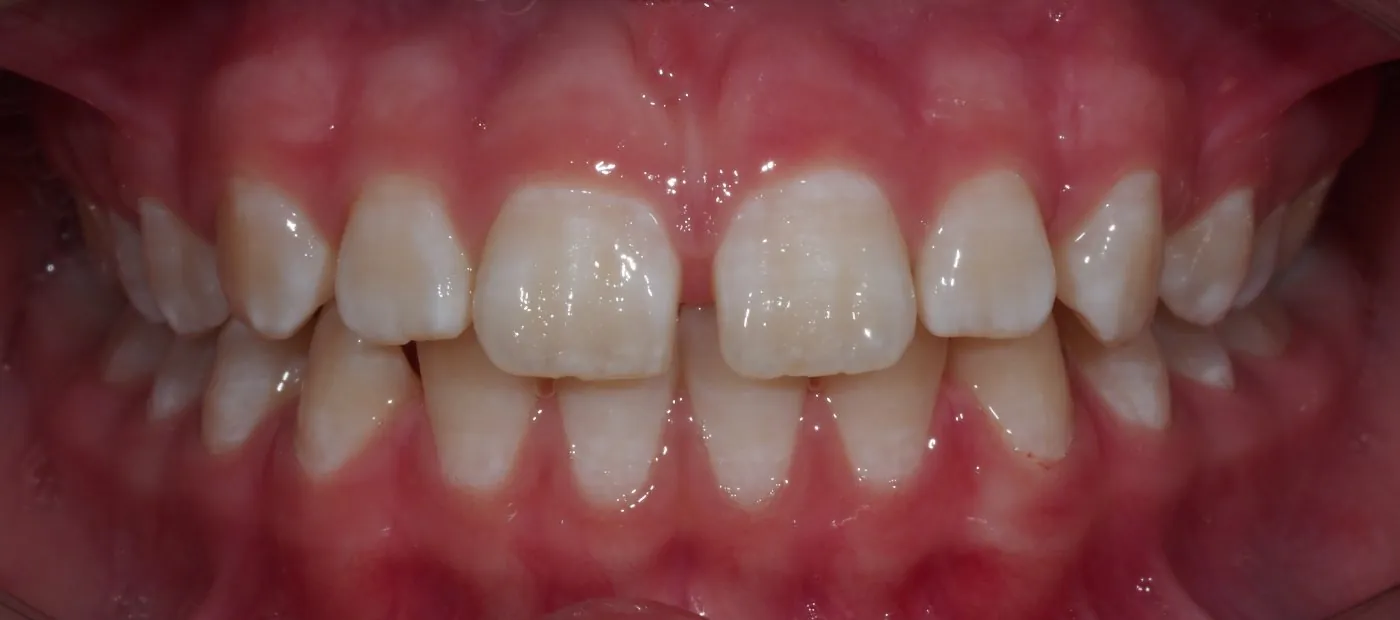 Before treatment