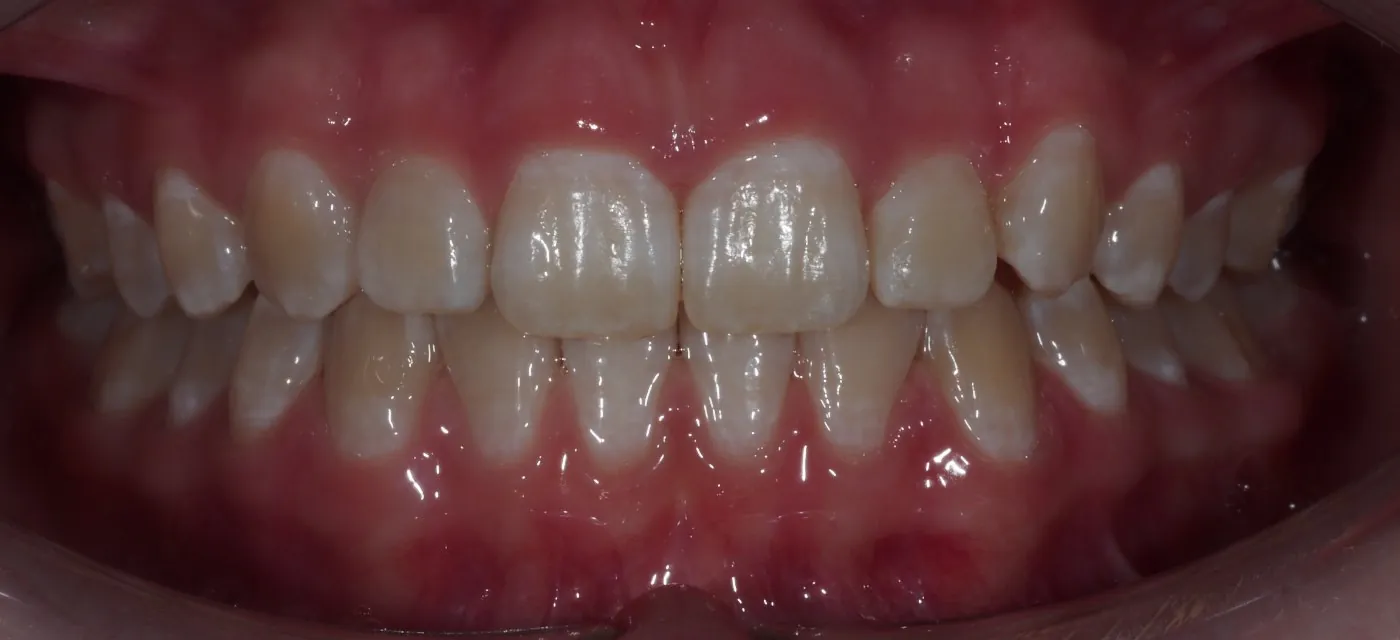 After treatment: close-up of the teeth after treatment