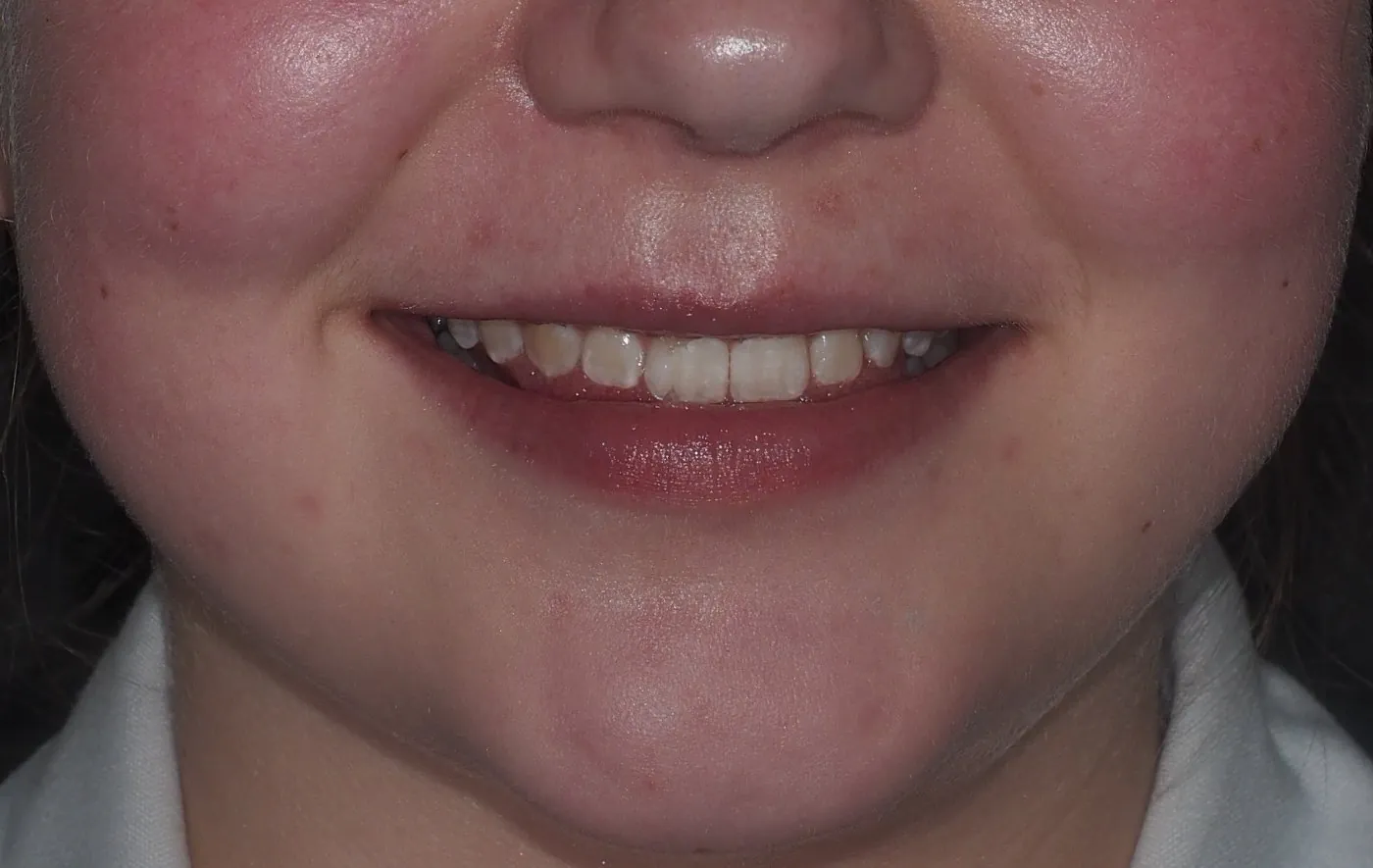 After: Closing gaps in a teenager’s front teeth with Invisalign