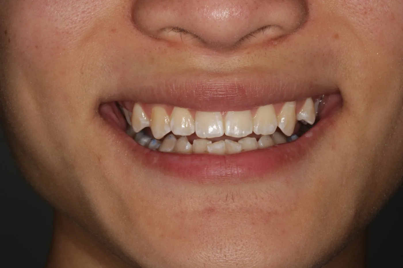 Before treatment