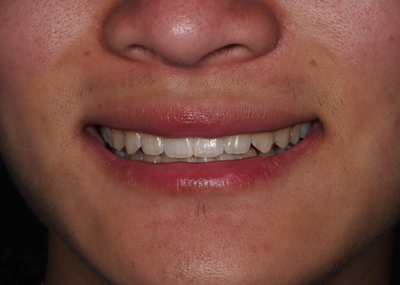 After: Straightening a university student’s crowded, pointy teeth