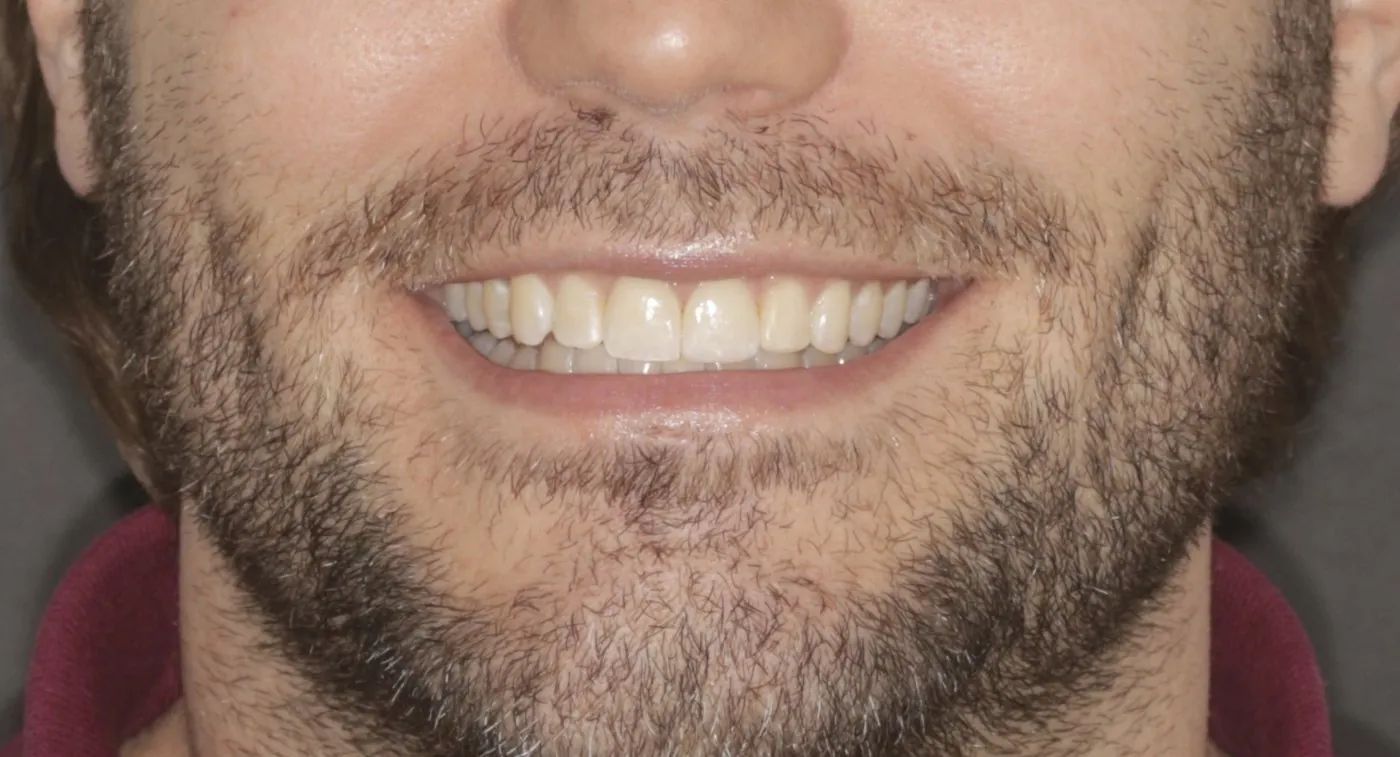 After: Four porcelain veneers for chipped, worn front teeth