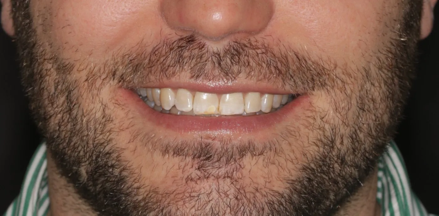 Before treatment