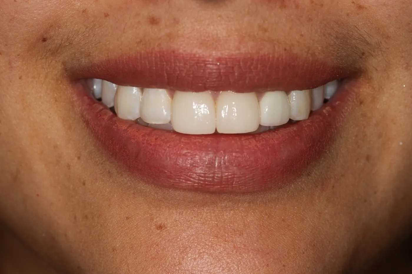 After: Four porcelain veneers for a dark root-canal tooth, still stable nearly 10 years on