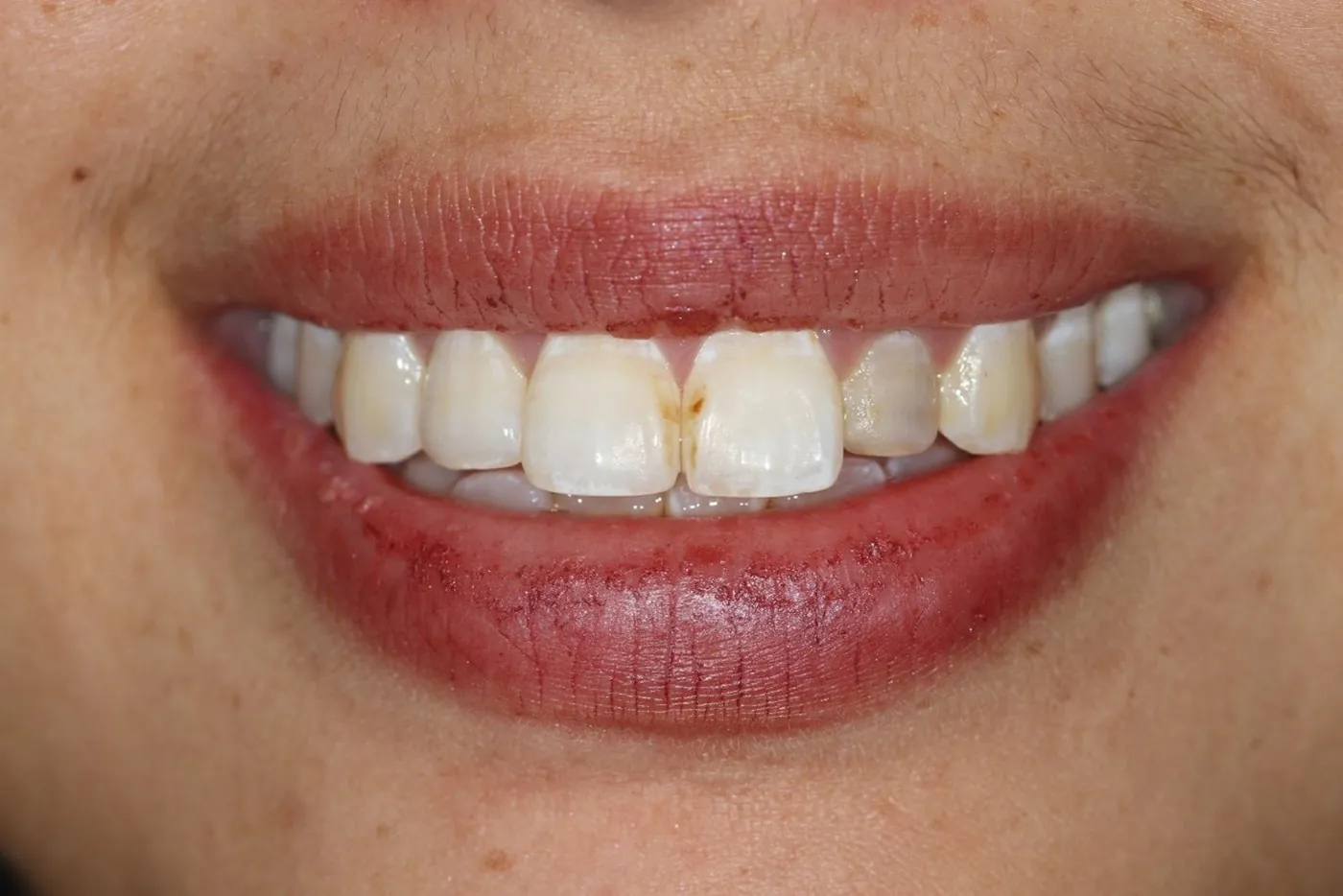 Before: Four porcelain veneers for a dark root-canal tooth, still stable nearly 10 years on