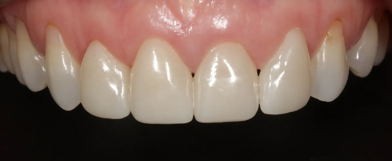 After: Four veneers for short, worn and discoloured front teeth