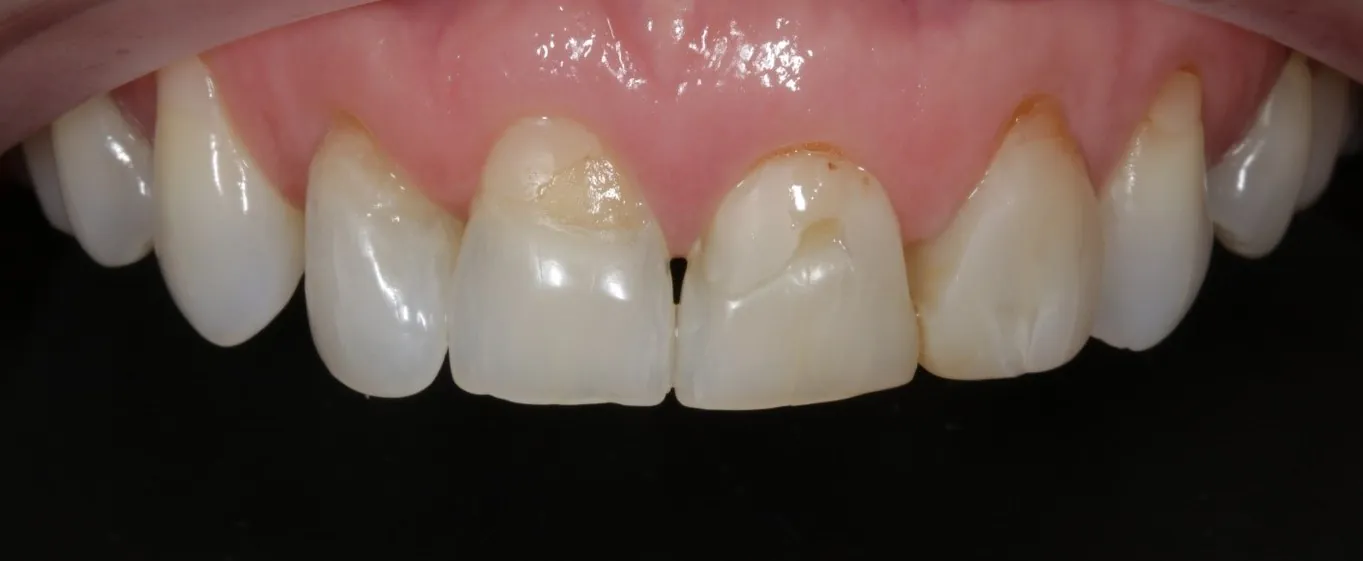 Before: Four veneers for short, worn and discoloured front teeth